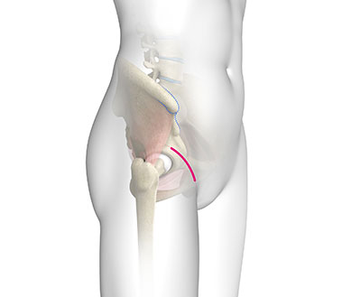 Hip Replacement