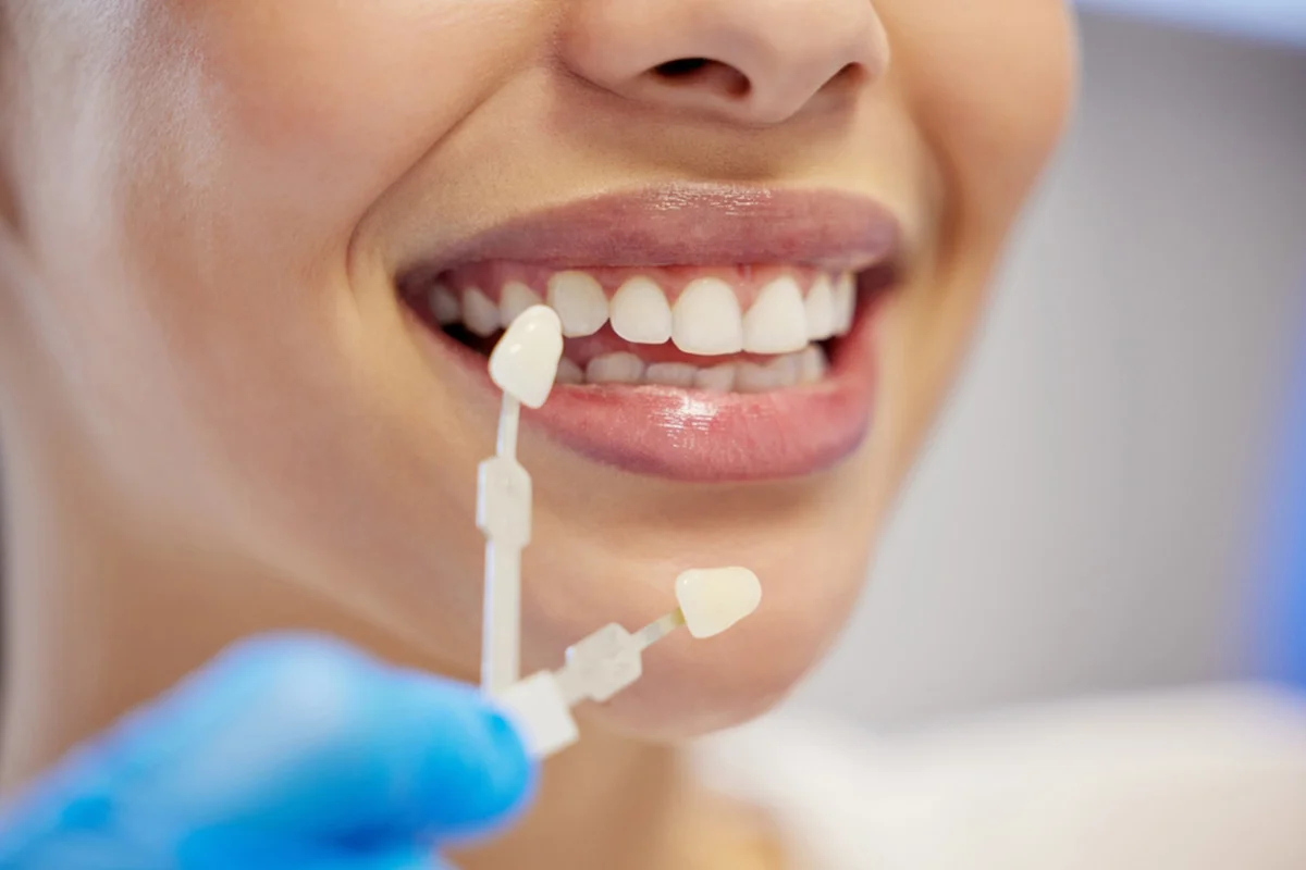 Dental Veneers