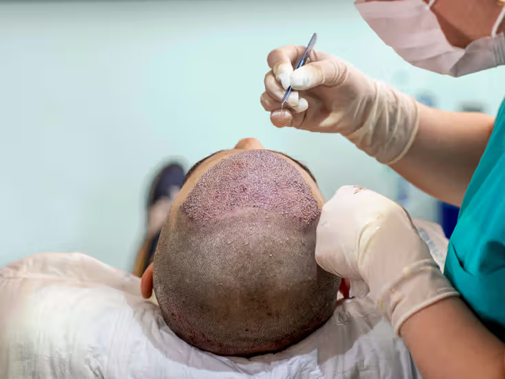 Hair Transplant (FUE)