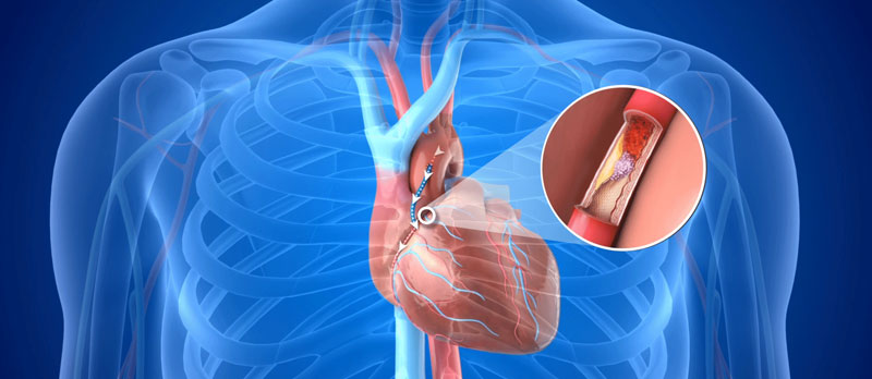 Heart Bypass Surgery (CABG)